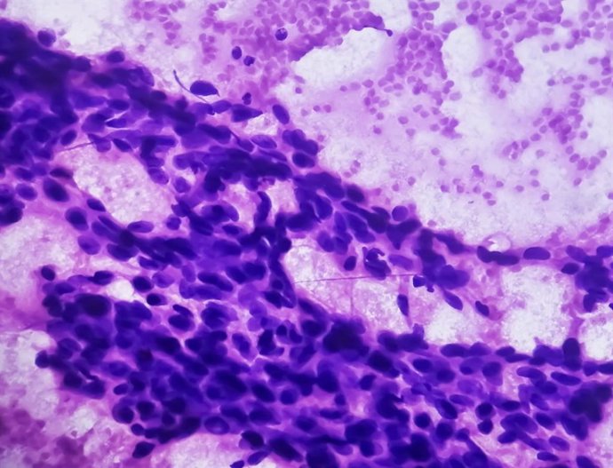 Un fármaco utilizado para suprimir la lactancia podría reducir el riesgo de cáncer de mama en las madres tras el parto