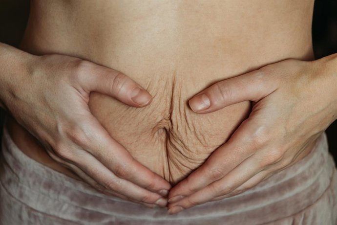 Archivo - Diástasis abdominal.