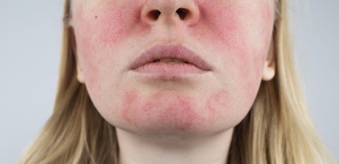 Archivo - Arquivo - Rosto com rosácea. A menina apresenta vermelhidão nas bochechas. Cuperose cutânea. A vermelhidão e a malha capilar são visíveis no rosto. Tratamento e eliminação. Cirurgia vascular e dermatologia