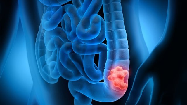 Archivo - Cancer de colon
