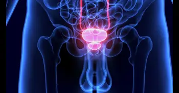 Teragnosis frente al cáncer de próstata avanzado: el tratamiento que localiza el tumor y lo trata desde dentro