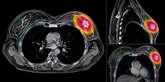 Foto: Una radioterapia de cinco días y mínimo volumen muestra resultados favorables en pacientes con cáncer de mama precoz