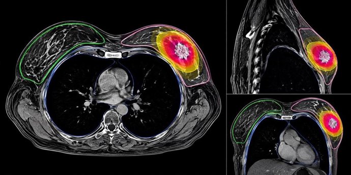 Imágenes de planificación de radioterapia de una paciente con cáncer de mama precoz.