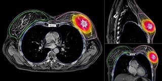 Imágenes de planificación de radioterapia de una paciente con cáncer de mama precoz.