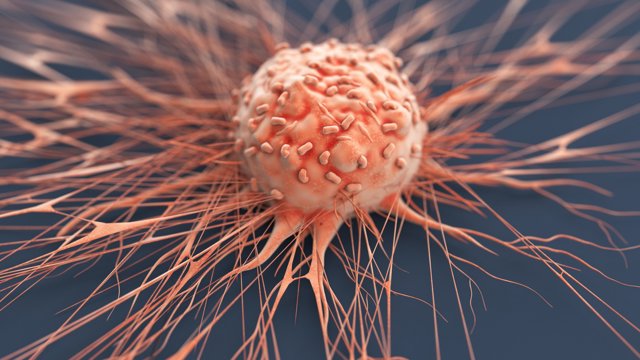 Archivo - Célula de cáncer humano.