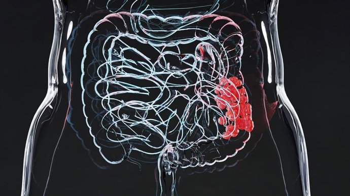 Archivo - Estudio internacional en Fase 1 obtiene resultados favorables con una terapia dirigida en cáncer colorrectal metastásico 