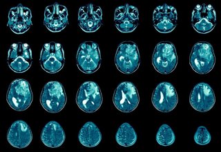 Archivo - Glioblastoma, cerebro metastasis