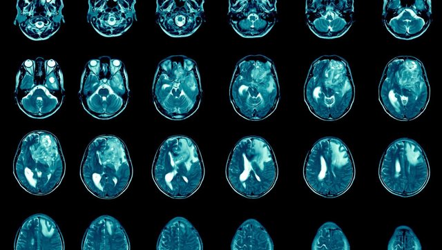 Archivo - Glioblastoma, cerebro metastasis